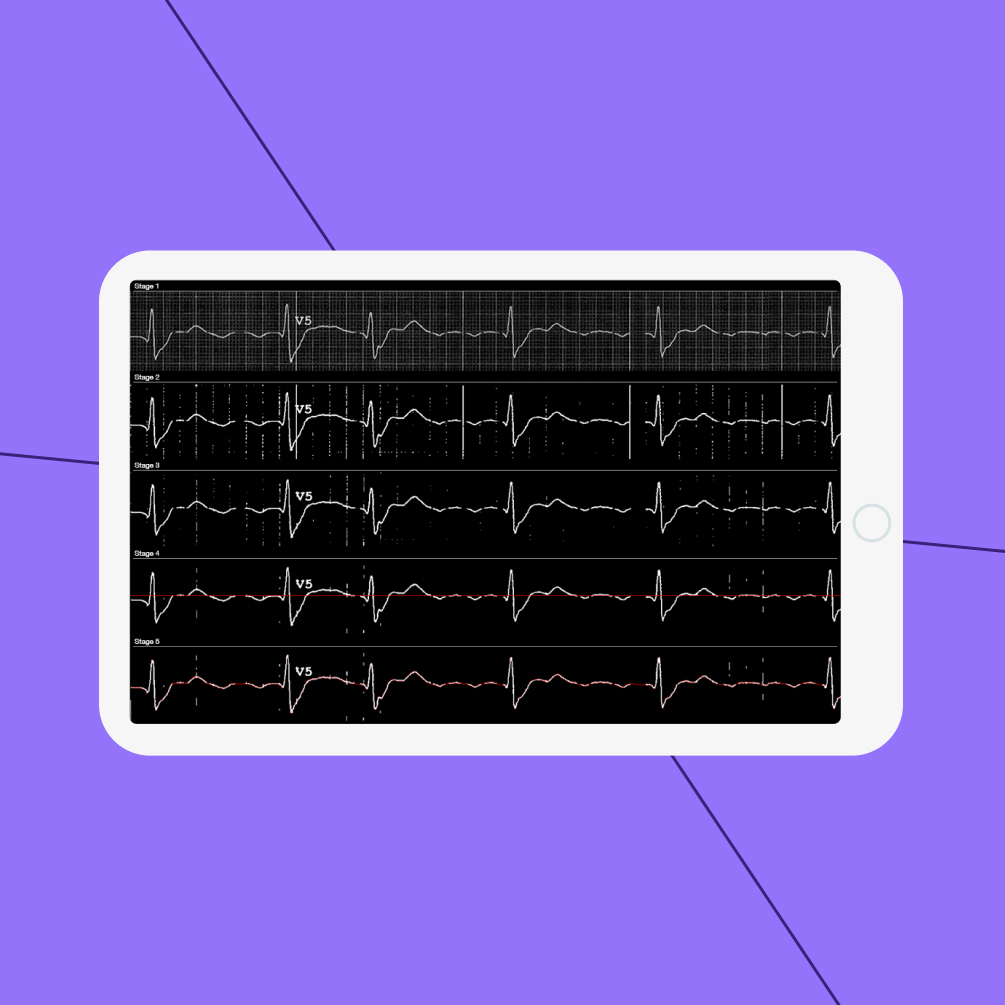 Computer Vision System for ECG digitization